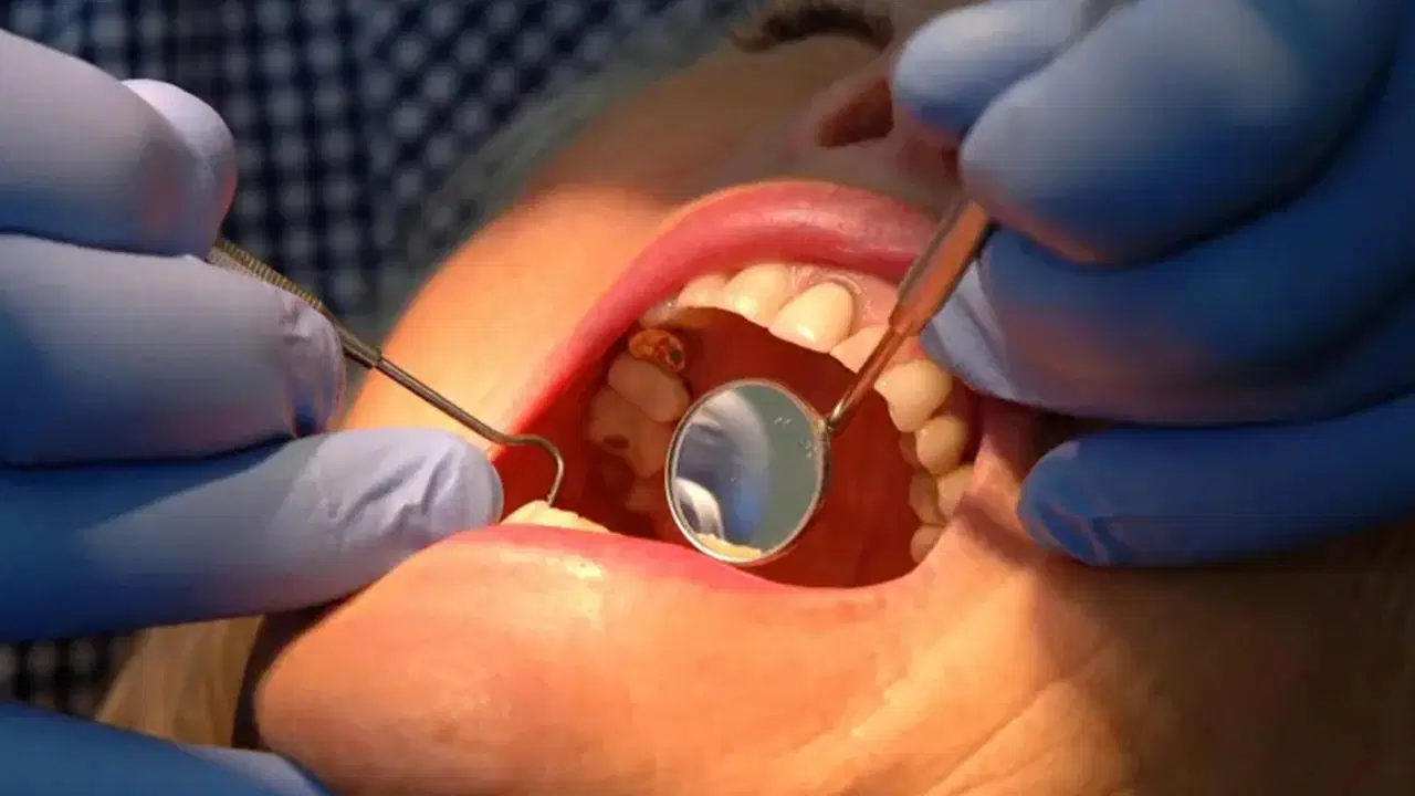 dis minesini onaran yeni jel curuklerin sonu mu geliyor WBKZ3SZr.jpg